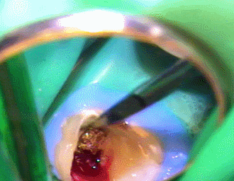 メタルコア除去 DF根 2015.09.03.gif